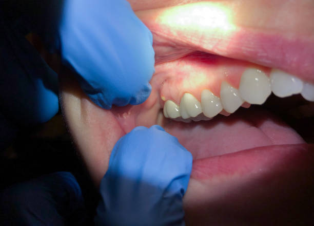 Best Emergency Gum Treatment in Harlem, FL